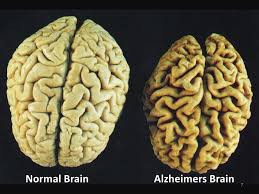 Normal Brain vs. Alzheimers Brain